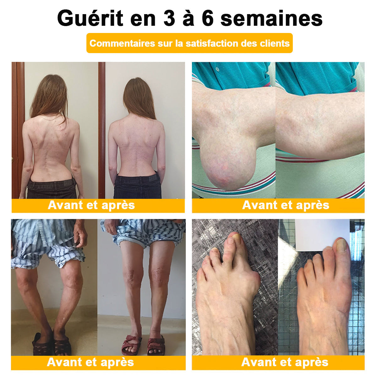 ADNOON® CRÈME DE GUÉRISON DES OS ET DE SOULAGEMENT DE LA DOULEUR AU BOTOX ET VENIN D'ABEILLE