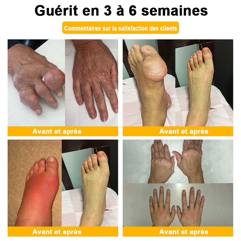 ADNOON® CRÈME DE GUÉRISON DES OS ET DE SOULAGEMENT DE LA DOULEUR AU BOTOX ET VENIN D'ABEILLE